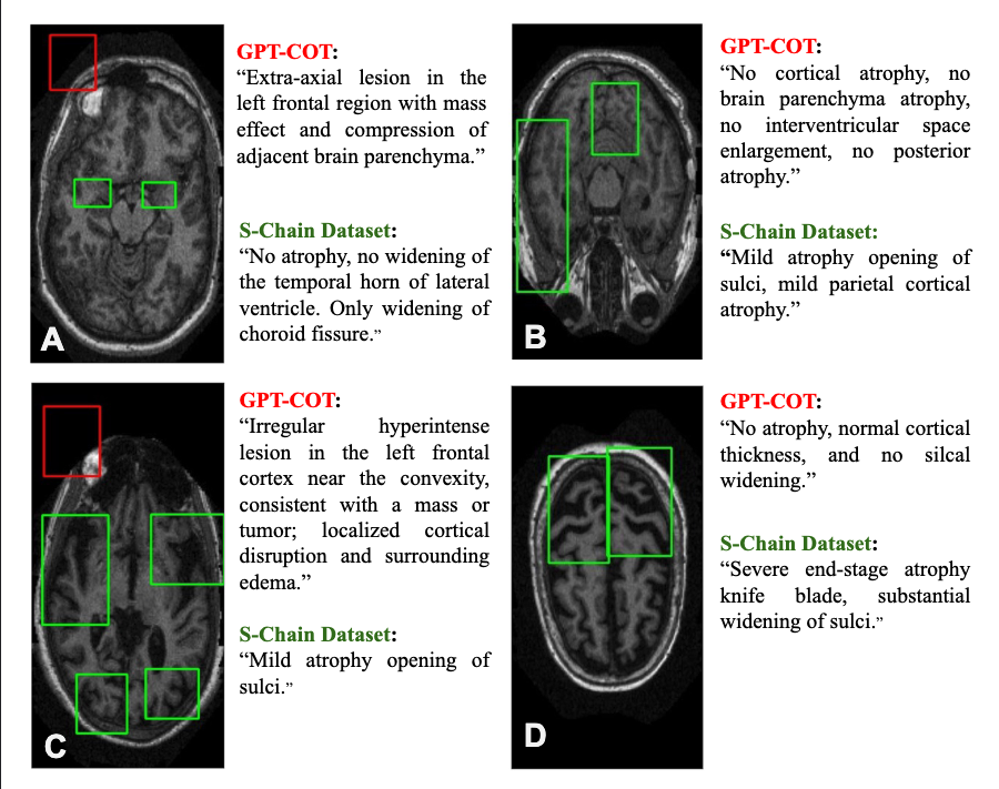 Comparison showing GPT-4.1 hallucination vs S-Chain ground truth